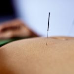 Acupuncture on Abdomen