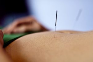 Acupuncture on Abdomen