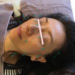 facial acupuncture