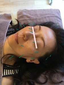 facial acupuncture