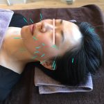 face acupuncture