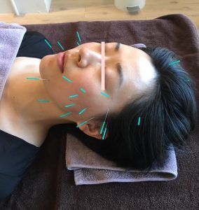 face acupuncture